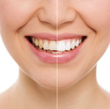 Fototapeta  - Before and after bleaching or whitening treatment, isolated