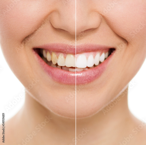 Fotografie, Obraz Before and after bleaching or whitening treatment, isolated
