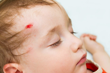 Little baby sleeping with a wound on his head