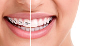 Healthy Smile With Braces
