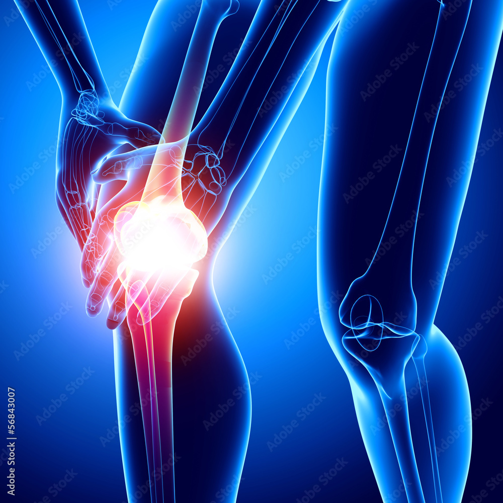 X-ray human of knee pain Stock Illustration | Adobe Stock