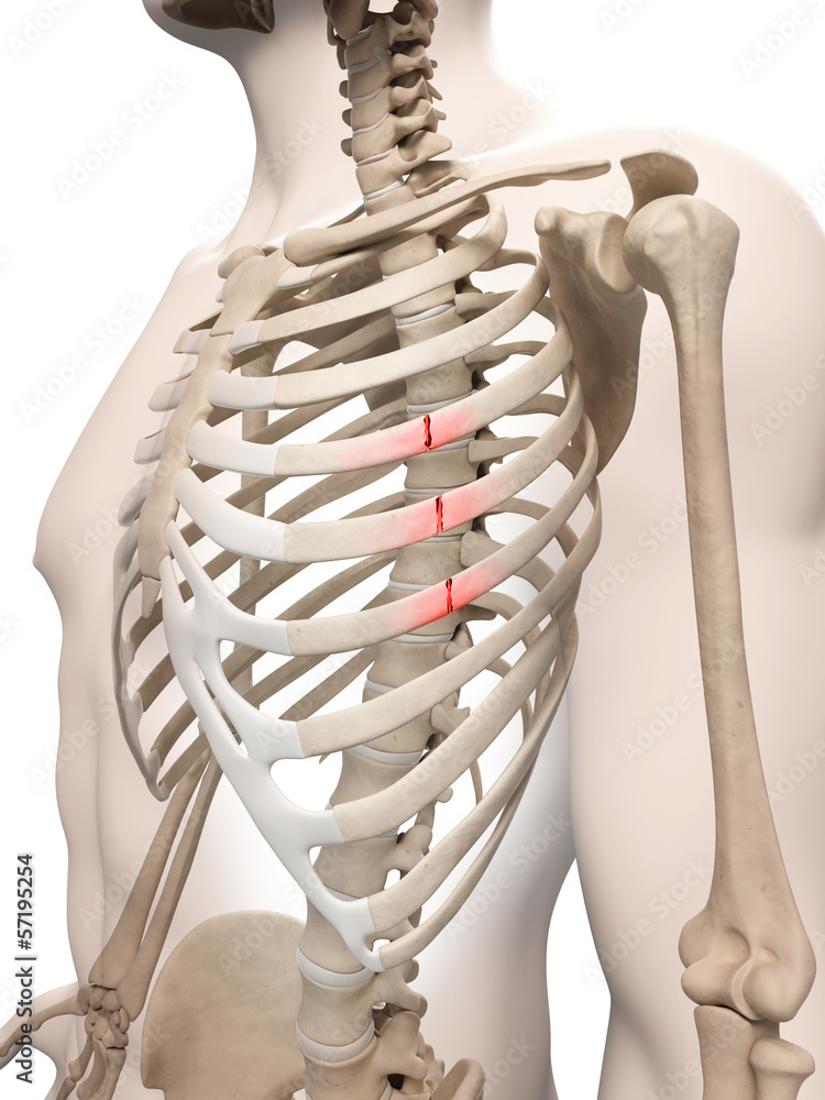 medical illustration of broken ribs Stock Illustration | Adobe Stock