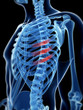 medical illustration of broken ribs