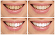 Teeth decay cure. Tooth whitening. Before and after.