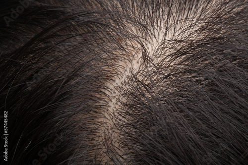 Thinning Hair And Oily Scalp Buy This Stock Photo And Explore