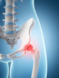 inflamed hip joint