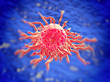 Cervical cancer cell, SEM of Cervical Carcinoma