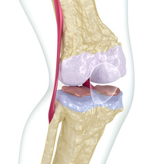 Osteoporosis of the knee joint.