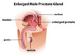 Enlarged male prostate gland