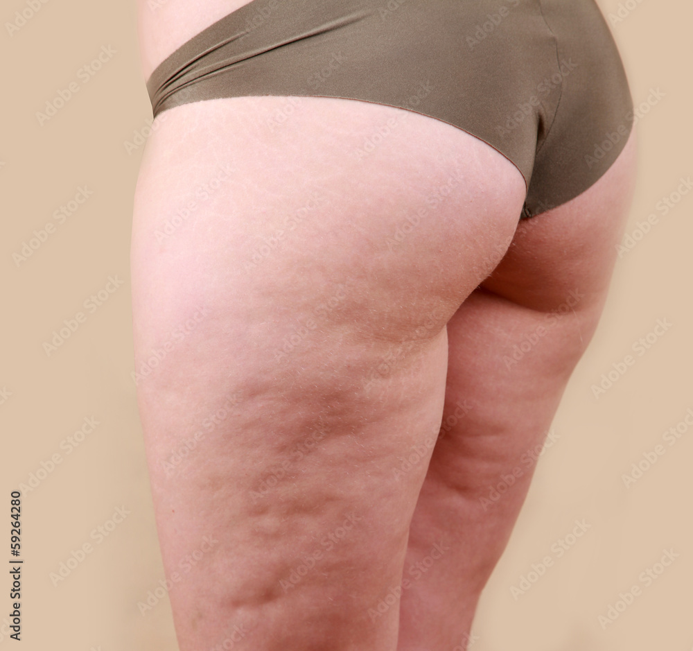 Cellulite skin at woman thighs - obrazy, fototapety, plakaty 
