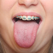 Close up smile with orthodontic braces and tongue.