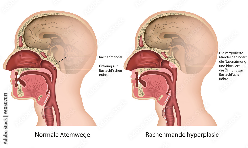 Rachenmandelhyperplasie, adenoide verformung deutsch - obrazy, fototapety, plakaty 