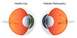 Comparison of health eye vs eye affected by diabetic retinopathy