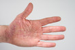 linke Hand Neurodermitis 871