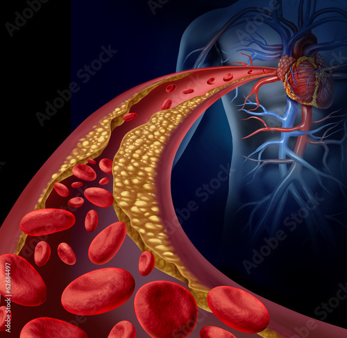 Nowoczesny obraz na płótnie Clogged Artery