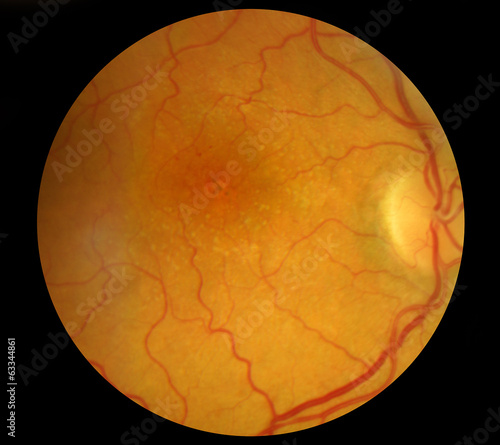 Cuadros en Lienzo Medical Fundus photo of retinal pathology, hemmorhages, vein occ