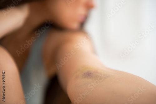 bruised womans arm on white background, domestic violence фотография Stock Adobe