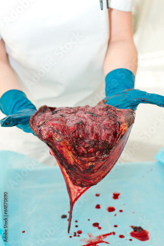 Fotografie, Obraz Midwife, a doctor examines the consequences, the placenta after
