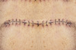 Stitches on belly