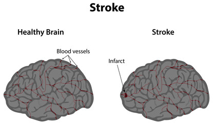 Stroke