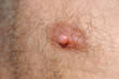 Male nipple