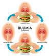 bulimia