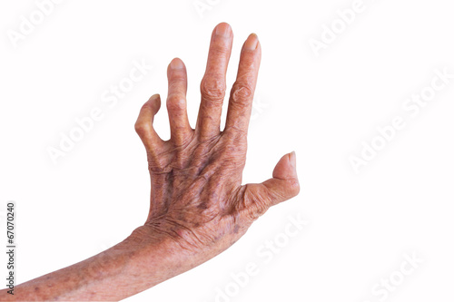 Fotografía left hand of a leprosy isolated on white background