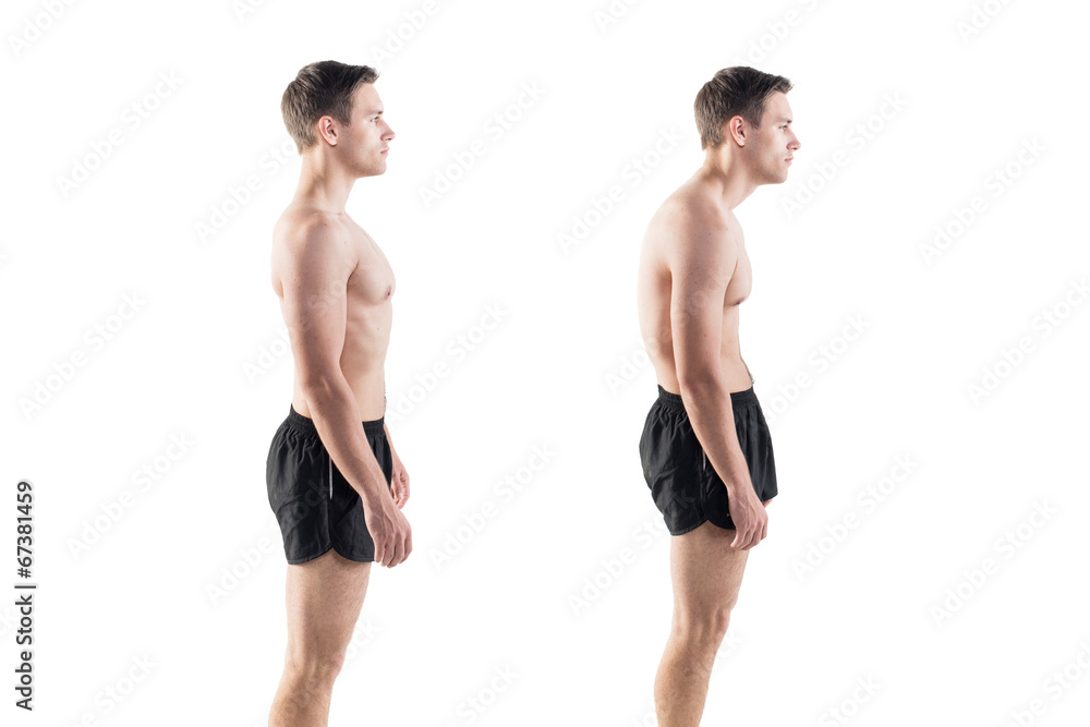 Man with impaired posture position defect scoliosis and ideal - obrazy, fototapety, plakaty 