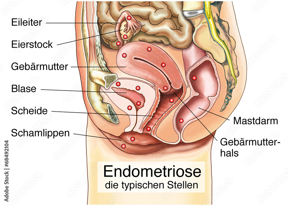 Fototapete Endometriose Weibliche Geschlechtsorgane Fototapeten Henrie