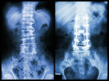 "Spondylosis" (Left Image) ,  Internal Fixation. (Right Image)