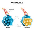 Pneumonia. Illustration shows normal and infected alveoli.