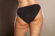 fat female buttocks with cellulite and stretch marks