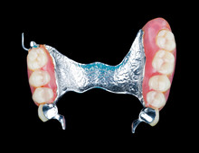 Removable Dental Prosthesis