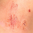 © schankz - wound on the skin. close-up