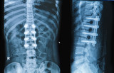 Fototapeta Do akwarium - x-ray image of back pain show spinal column with implant fusion