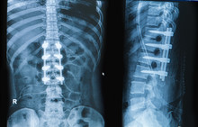 X-ray Image Of Back Pain Show Spinal Column With Implant Fusion