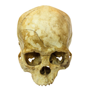 Human Skull Fracture(top side,apex)(,Asian) on isolated