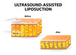 Ultrasound-assisted liposuction