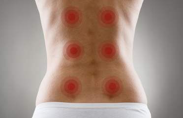 Acupressure shown with red spots on woman's back