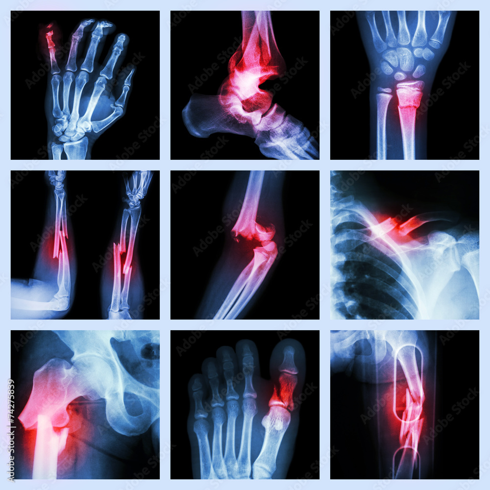Collection of bone fracture Stock Photo | Adobe Stock