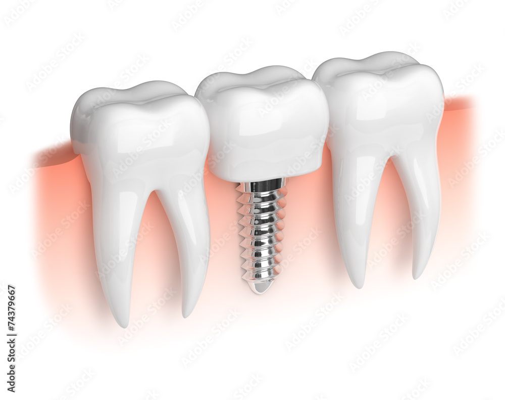Model of white teeth and dental implant - obrazy, fototapety, plakaty 