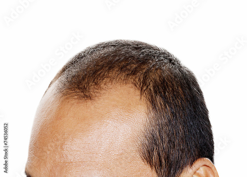 Hair Loss Male Head With Hair Loss Symptoms Front Side Buy This
