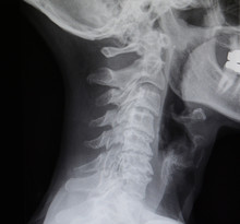 Human Spine X-Ray