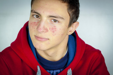 Portrait of teenage boy with acne