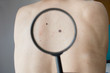 Checking melanoma on the back of a man