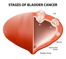 Cancer Bladder