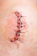 © dziewul - scar from operation with a black fiber
