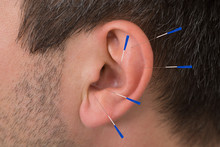 Acupuncture Needles On Ear