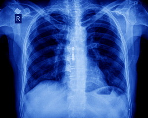 Naklejka na meble xray of chest