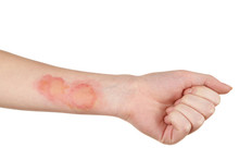 Horrible Burns On Female Hand Isolated On White